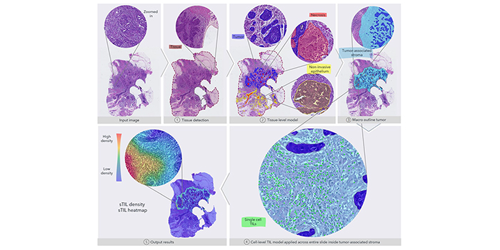 Figure from the article in Cancers, 18 June 2021: Automated Quantification of sTIL Density with H&E-Based Digital Image Analysis Has Prognostic Potential in Triple-Negative Breast Cancers. Figure 1 Overview of the fully automated image analysis pipeline. The input data are the scanned WSI of a TNBC patient, which is then analyzed by multiple steps. First, the tissue (dark red) is recognized from the glass to limit the analysis to only the relevant part of the scanned slide. Secondly, the tissue-level model classifies slide regions into tumor tissue (blue), non-invasive epithelium (yellow), and necrotic regions (red). In the third step, the macro-outline of the tumor is approximated, and then tumor-associated stroma and margin (turquoise) are defined. Cells across the entire sample in the tumor-associated stroma are classified as TILs (green) or not, and finally, the sTIL density and heatmap can be outputted for review.